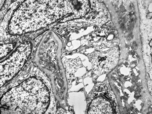 M,52y. | cylindroma - salivary gland M,52y. | cylindroma - salivary gland
